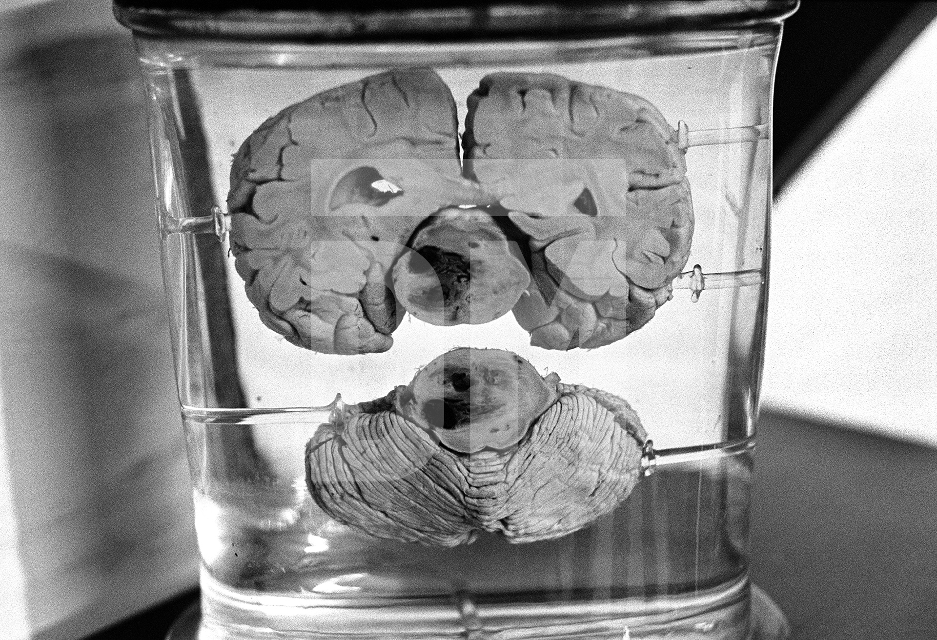 The hospital keeps a small museum of objects to assist in staff training, including quite an array of brains in bottles. February 1978 by Daniel Meadows