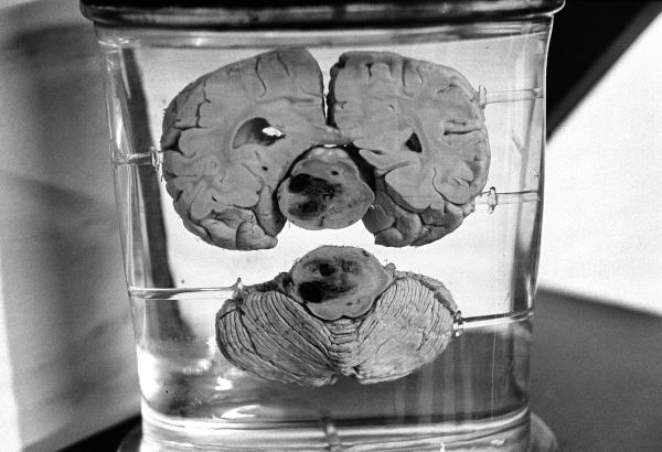 The hospital keeps a small museum of objects to assist in staff training, including quite an array of brains in bottles. February 1978